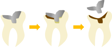 セラミック治療と比較して虫歯の再発率が高まります。